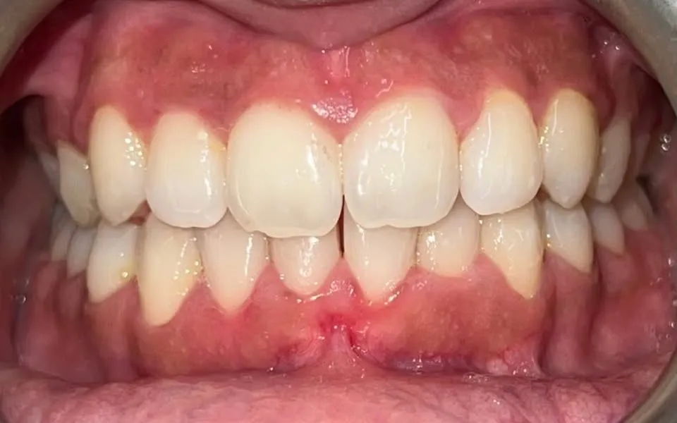 The same teeth after orthodontic treatment, evenly aligned