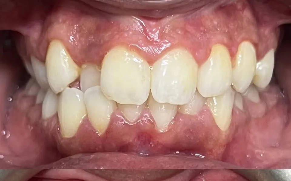Teeth before treatment, with crowding