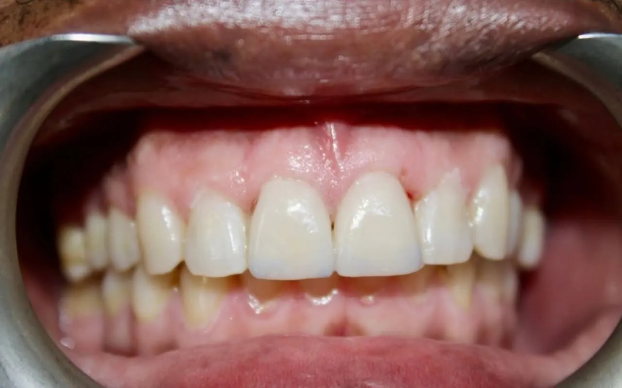 The same front teeth restored to a natural shape and shade