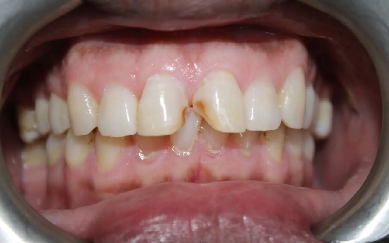 Worn and chipped front teeth before treatment
